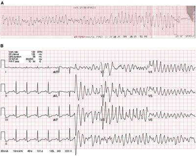 Case Report: Lacosamide unmasking SCN5A-associated Brugada syndrome in a young female with epilepsy